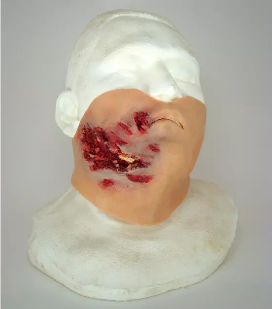 Techline Moulage Broken jaw with laceration